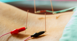 Electric Acupuncture